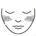 Melasma & Pigmentation